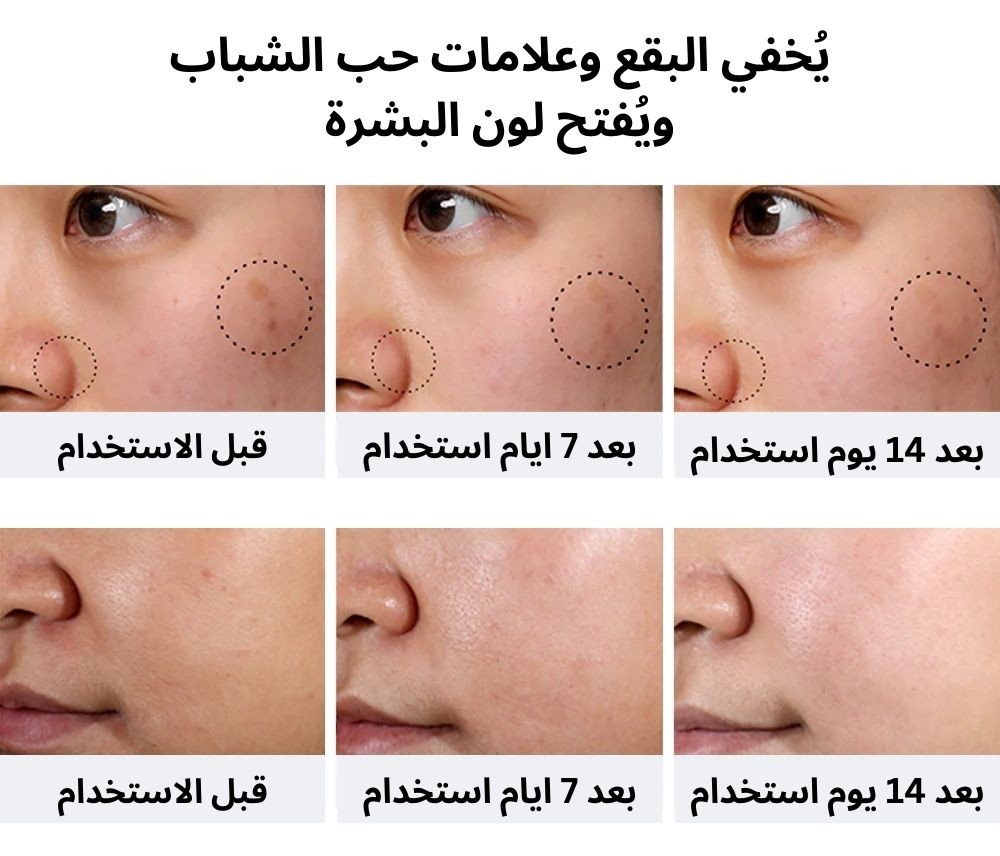 سيرم النياسيناميد لتفتيح البقع السوداء