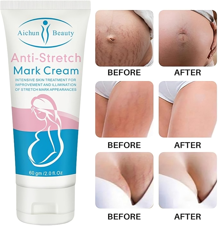 كريم إزالة علامات تمدد الحمل