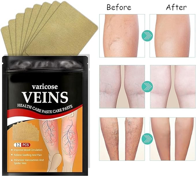 رقعة علاج الأوردة