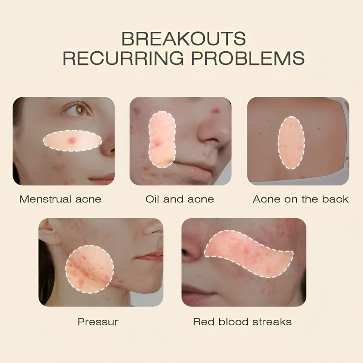 جل سم النحل المضاد لحب الشباب