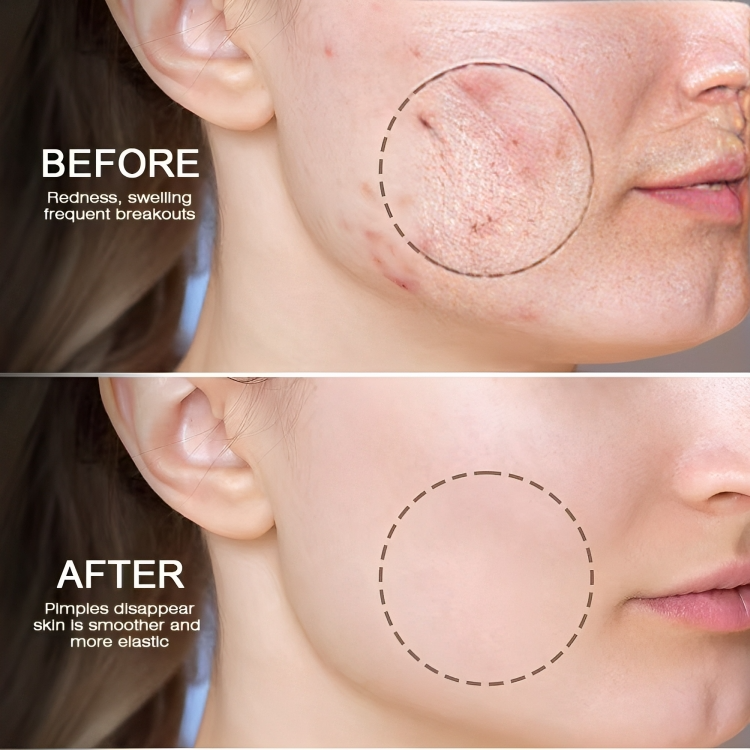 جل سم النحل المضاد لحب الشباب