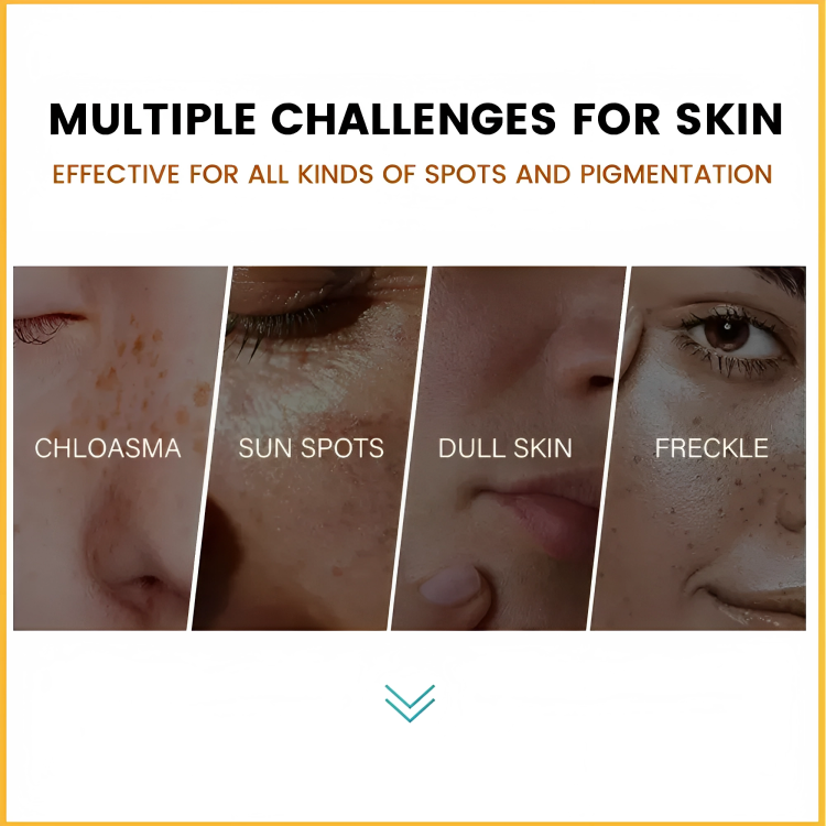 كريم ولوشن لعلاج الكلف للوجه بسم النحل