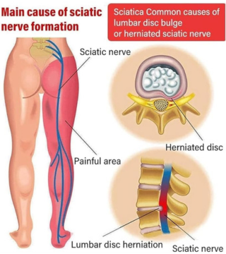 بخاخ لتخفيف آلام الركبة