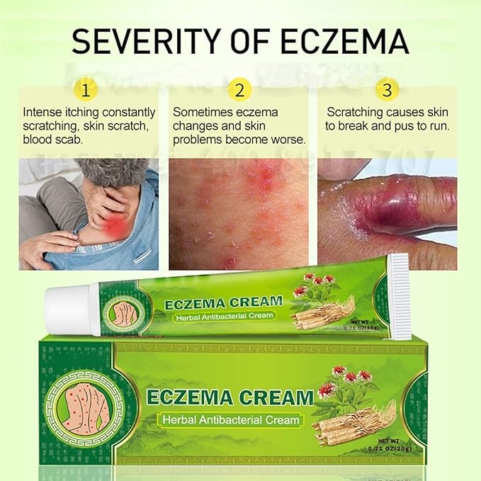 العناية بالبشرة الأكزيما