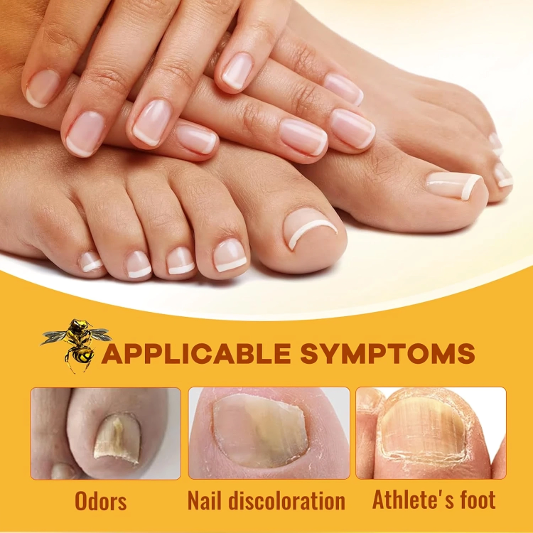 كريم علاج فطريات أظافر القدم بسم النحل