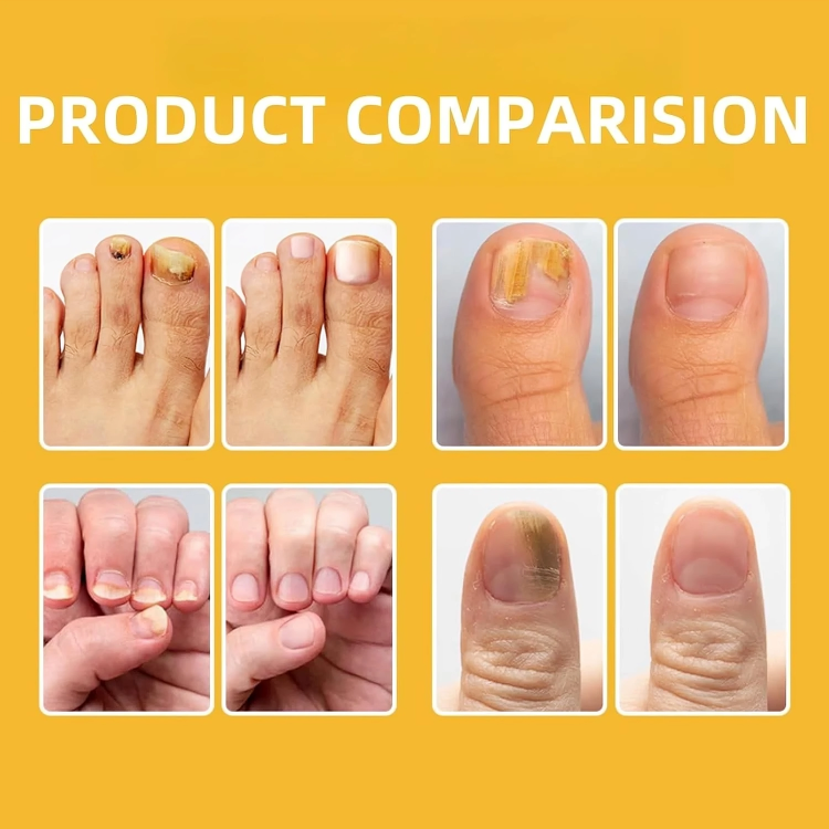 كريم علاج فطريات أظافر القدم بسم النحل