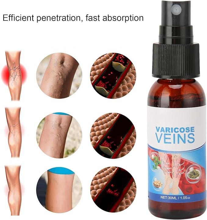 رذاذ للدوالي