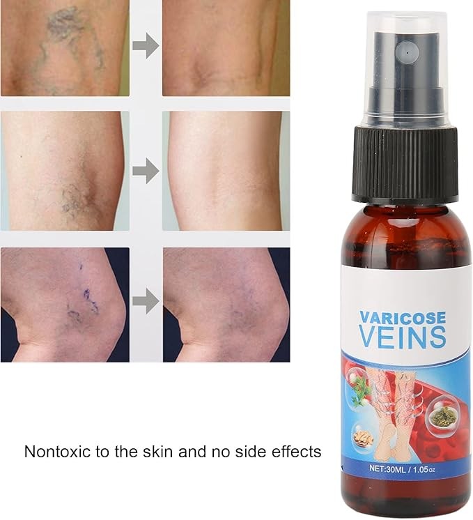 رذاذ للدوالي