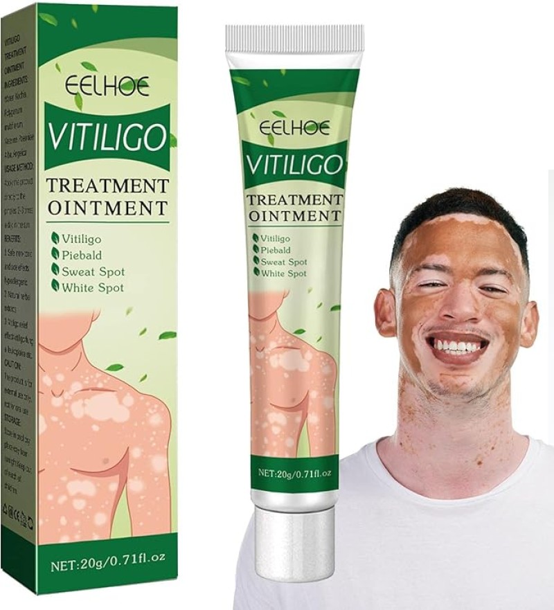 كريم علاج البهاق