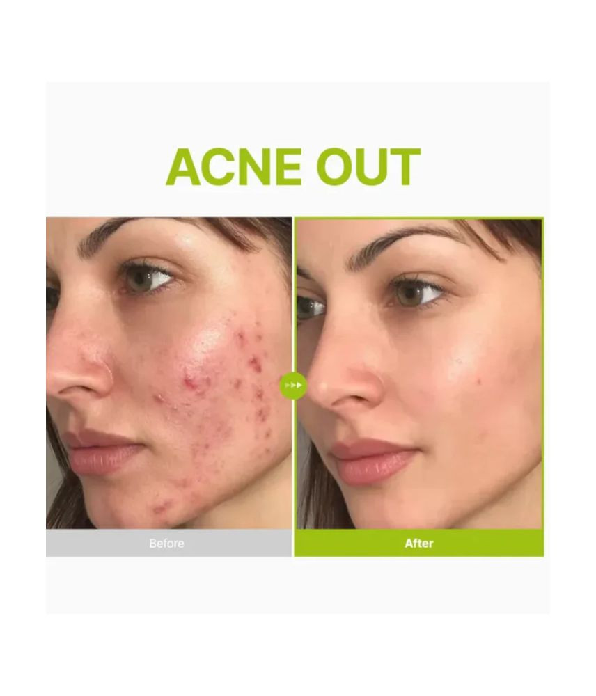 سيروم بوريـتو سيؤول بالأزيلاك أسيد 10%