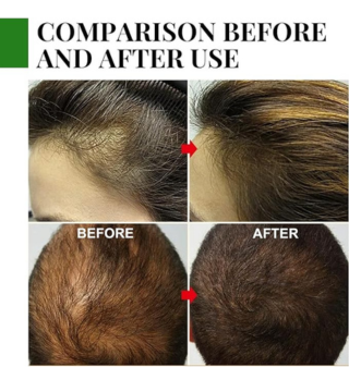 زيت الروزماري لنمو الشعر