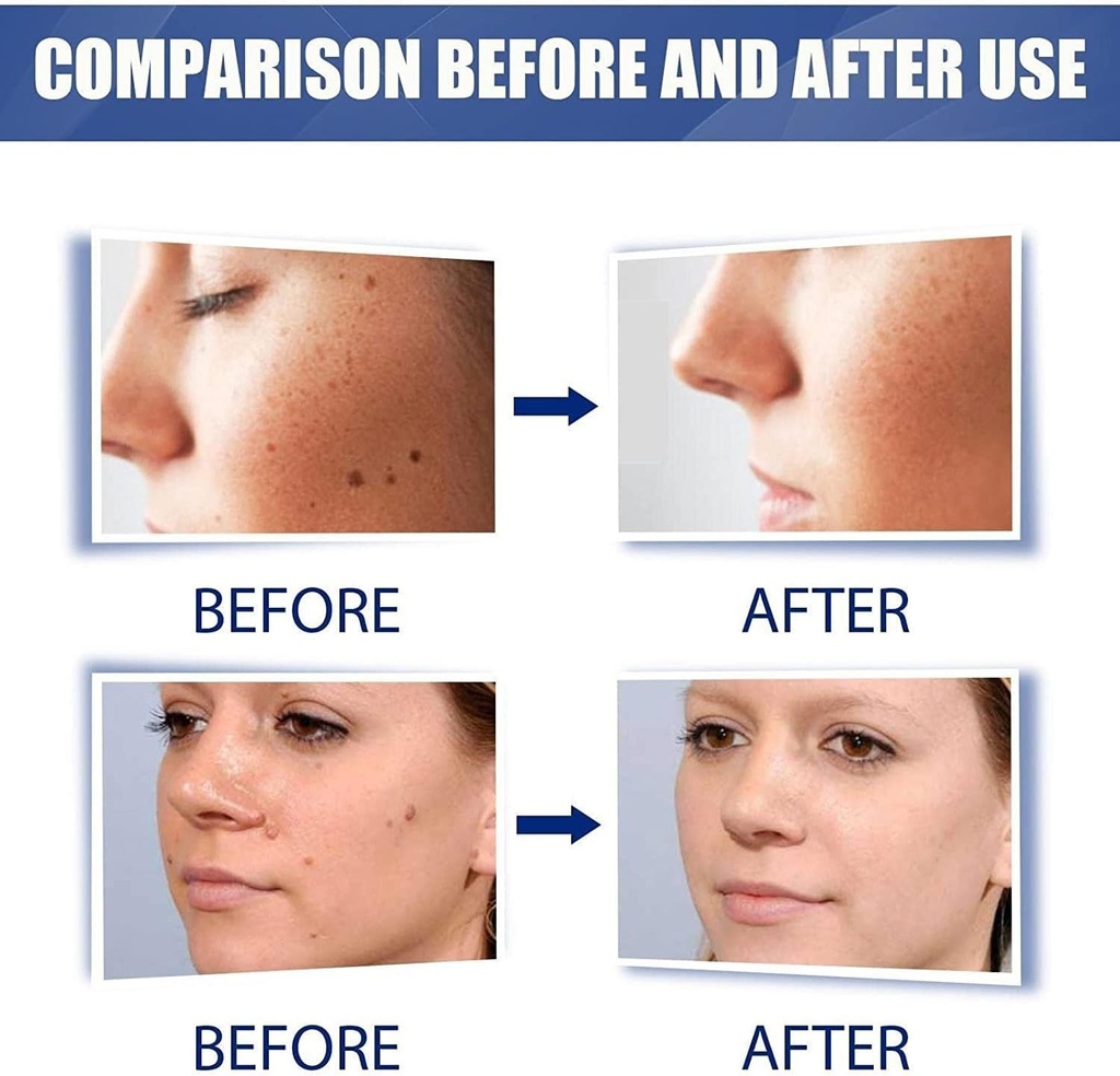 مرهم إزالة الزوائد الجلدية