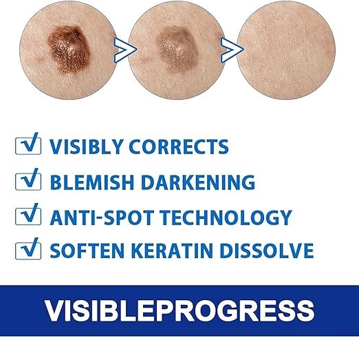 مرهم إزالة الزوائد الجلدية