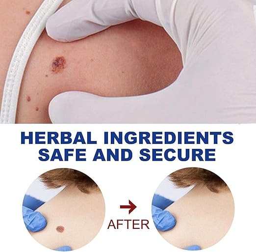 مرهم إزالة الزوائد الجلدية