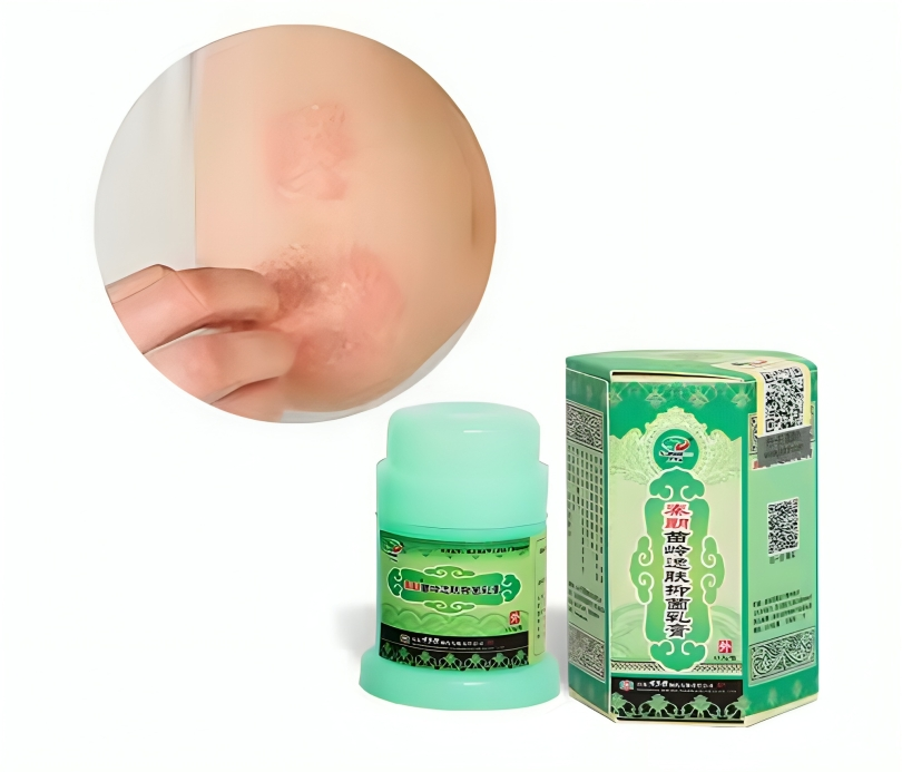 كريم علاج الأكزيما الأصفر