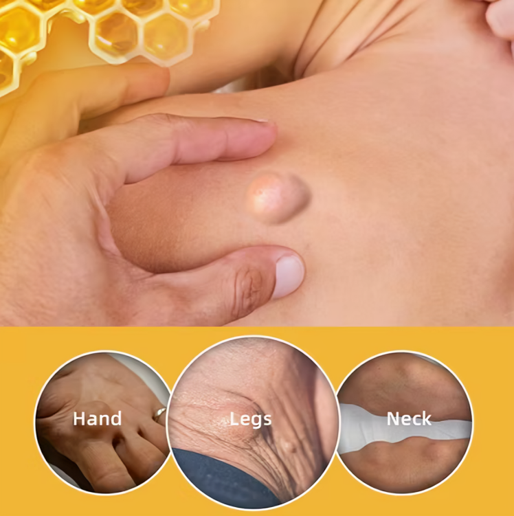 مرهم سم النحل للتخلص من الأورام الشحمية