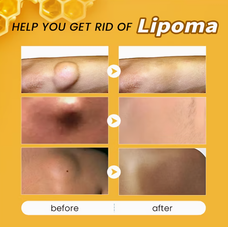 مرهم سم النحل للتخلص من الأورام الشحمية