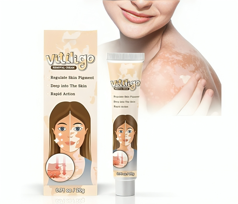 كريم علاج البهاق والبقع البيضاء