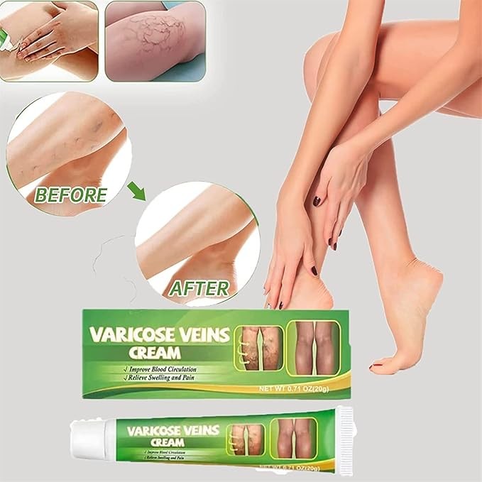 كريم علاج الدوالي