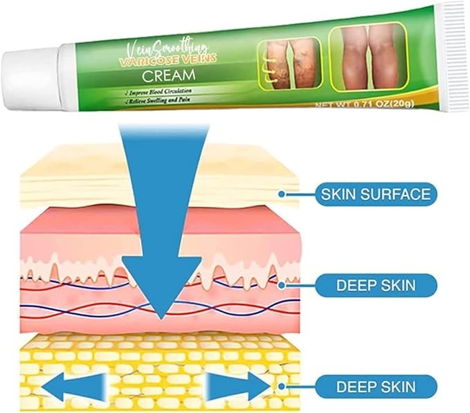 كريم علاج الدوالي