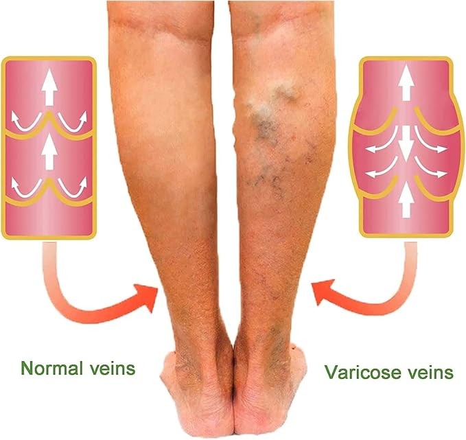 كريم علاج الدوالي