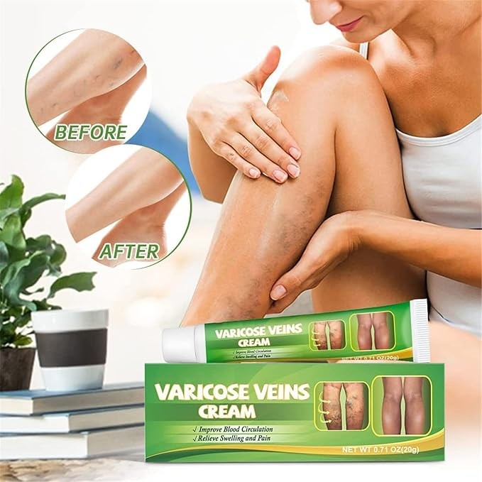 كريم علاج الدوالي